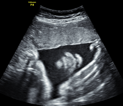 产科胎儿图片