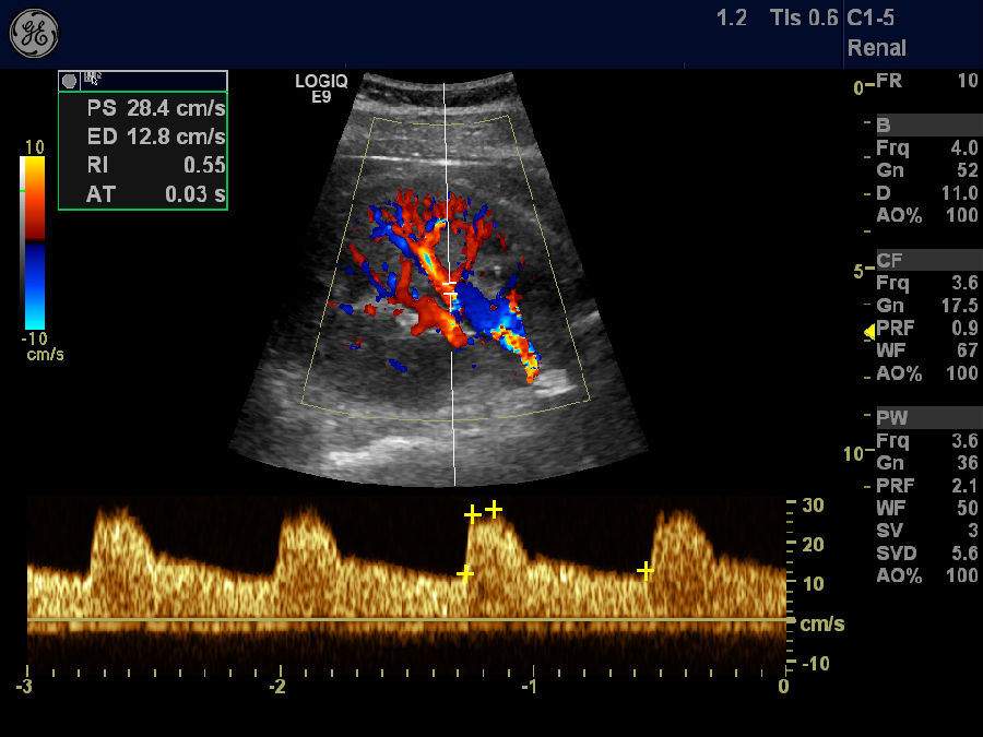 肾脏血流 肾脏长轴切面,肾脏血管树,段动脉频谱多普勒成像 肾脏多发
