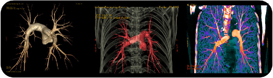 图片show——新能谱技术在肺动脉cta成像中的应用