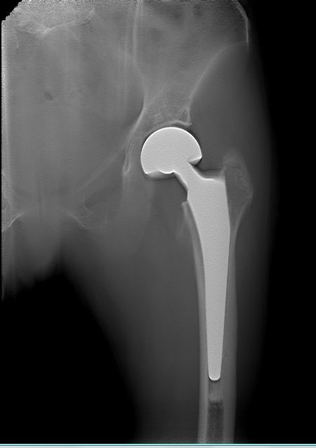 容积病例-左侧股骨头置换术后