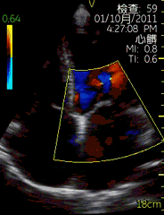 vscan临床图片 心脏