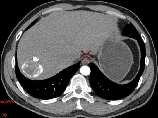 肝右叶环形高密度影
