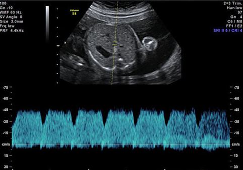 胎儿静脉导管超声图片图片
