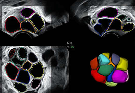 妇科_卵巢_三维超声:卵泡立体结构