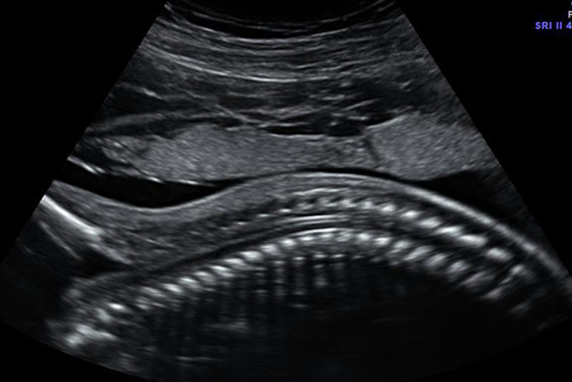 正常胎儿四维脊柱图图片