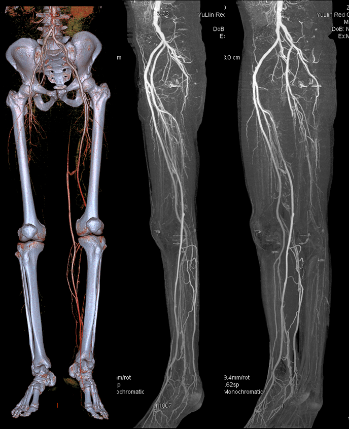 下肢动脉cta解剖图图片