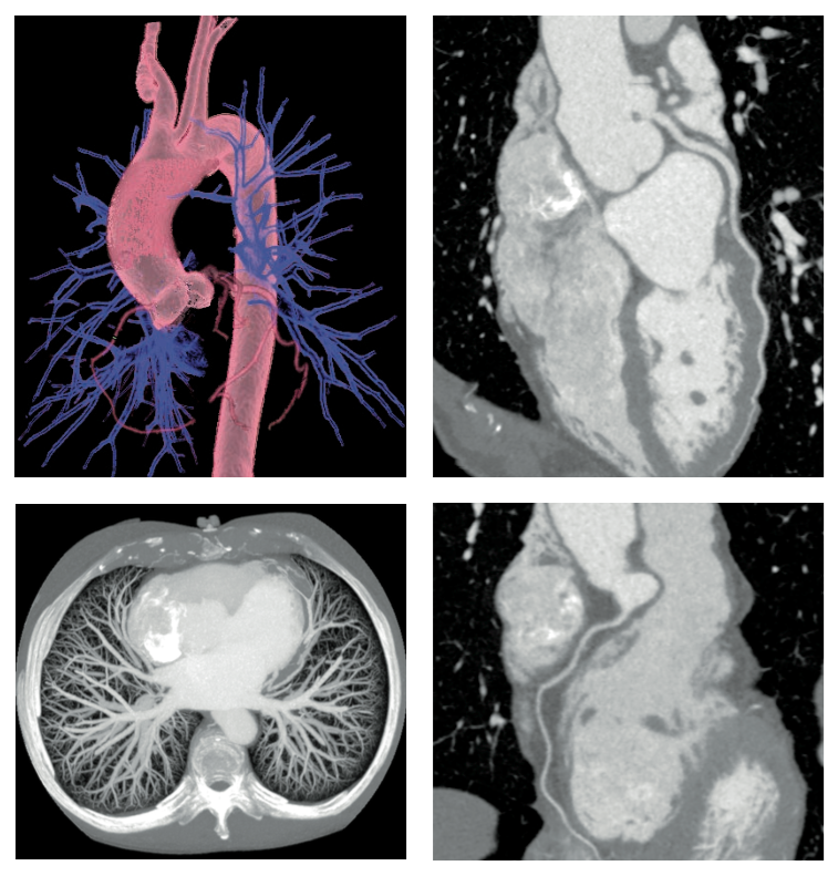 revolution ct临床病例5——完美的胸痛三联检查