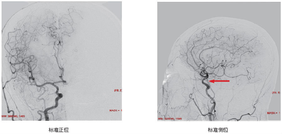 后交通动脉壶腹与后交通动脉瘤的鉴别诊断