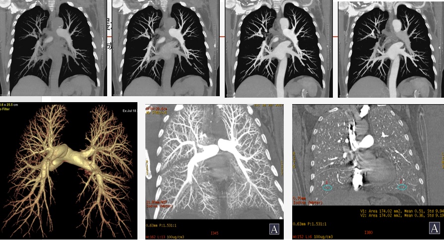 强化培训：CT肺动脉成像 1