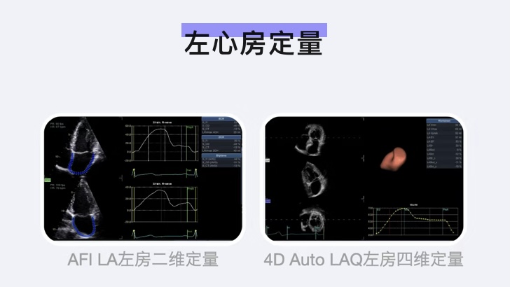Vivid系列 定量分析：四维左房定量分析（4D Auto LAQ）操作流程