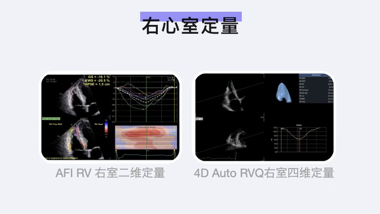 Vivid系列 定量分析：四维右室定量分析（4D Auto RVQ）操作流程