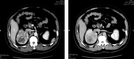 右肾透明细胞癌并右肺下叶转移瘤