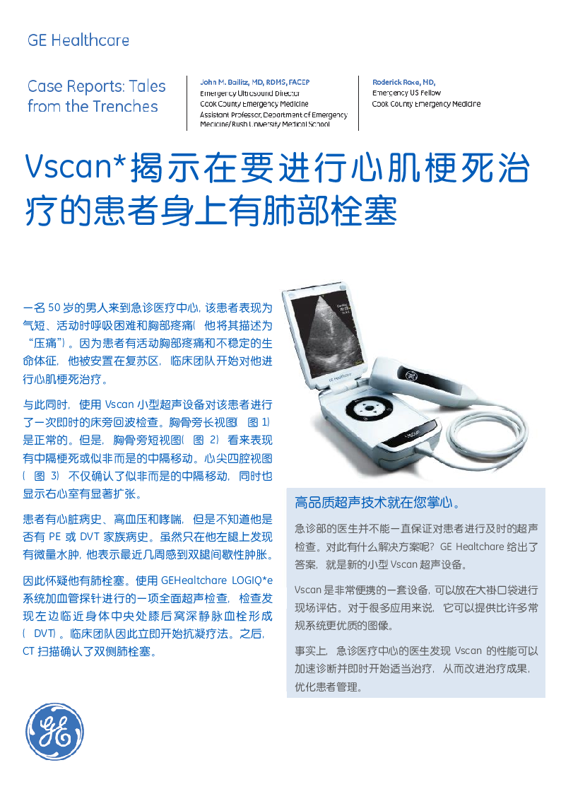 病例分析：Vscan发现在要进行心肌梗死治疗的患者身上有肺部栓塞