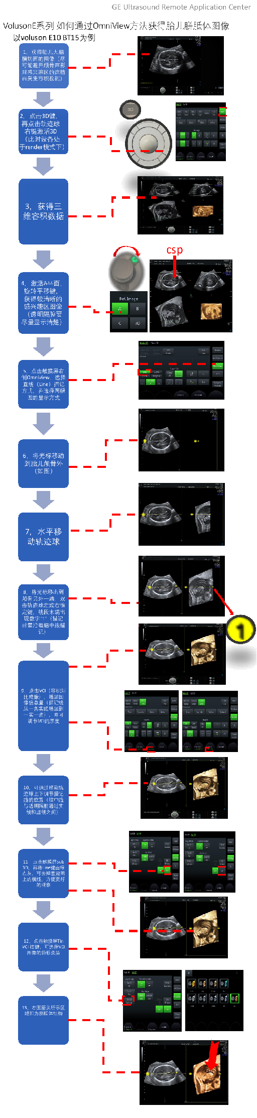 Voluson E系列 如何用omniview获得胎儿胼胝体图像